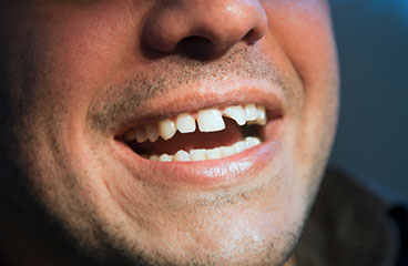 Chipped or Broken Teeth